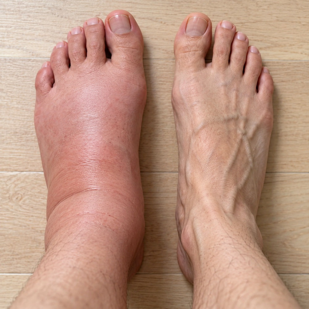 A swollen foot next to a normal one at the end of a day